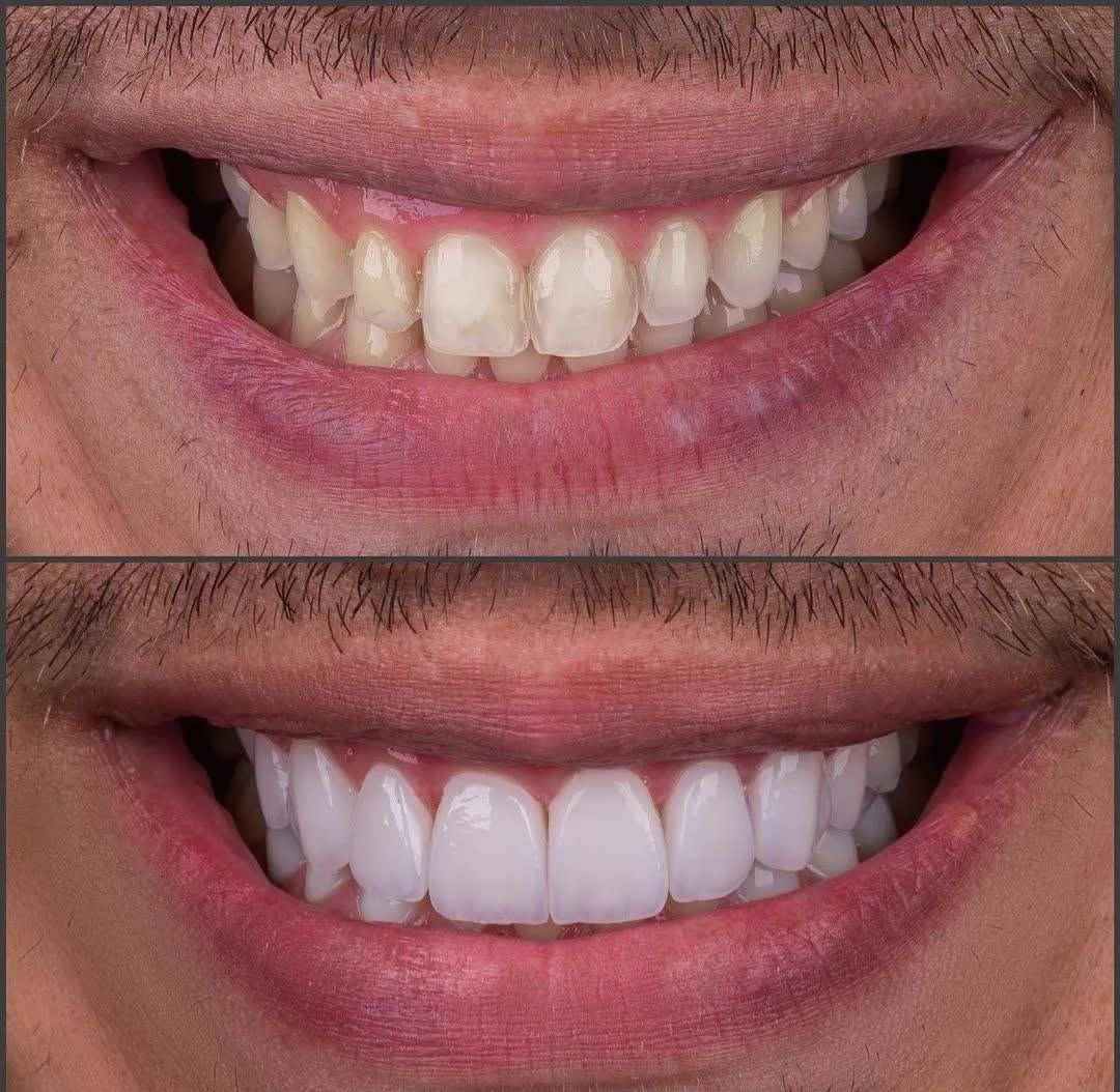 HOLLYWOOD SMILE with EMAX